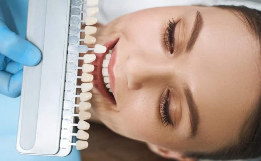 Teeth Veneers in Gold Coast